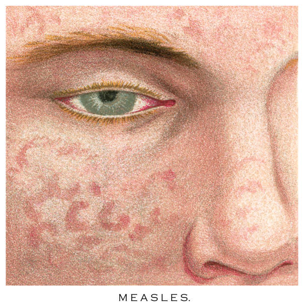 How to Identify and Treat a Macular Rash: Causes and Solutions